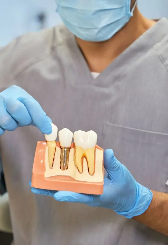 Implante Dentário em Cerqueira Cesar São Paulo - SP