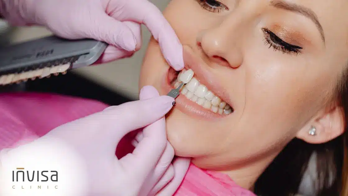 Lentes de contato dentais com sorriso branco e natural após aplicação