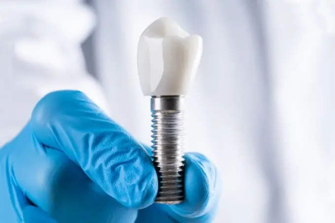 Implante de Dentário