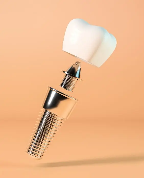 Tipos de implante dentário