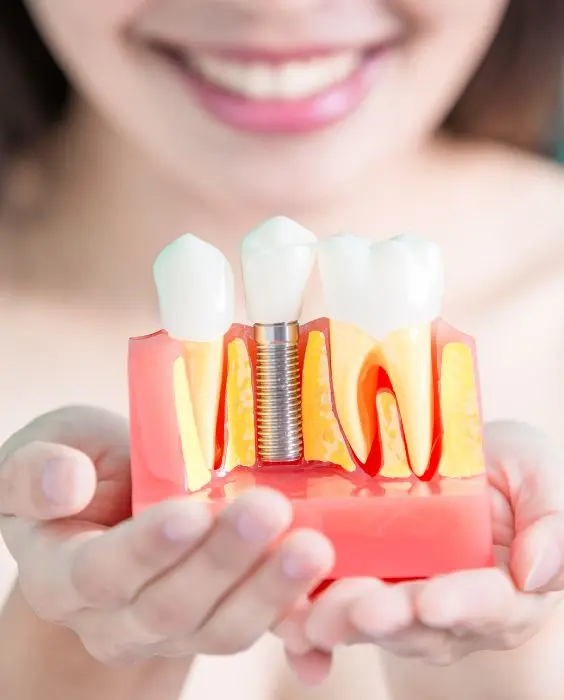 Implante dentário em São Paulo, SP