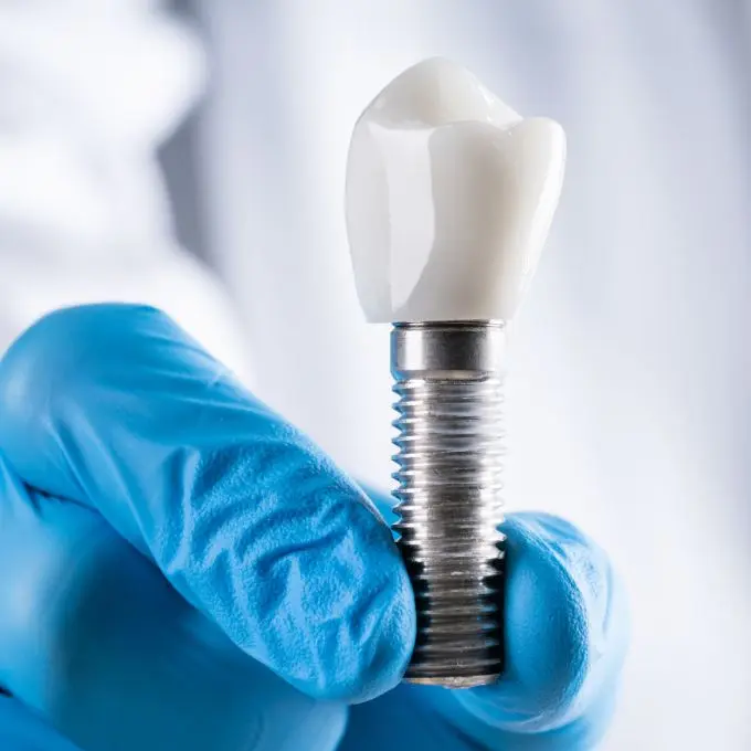 Implante Dentário em Itaim Bibi São Paulo - SP