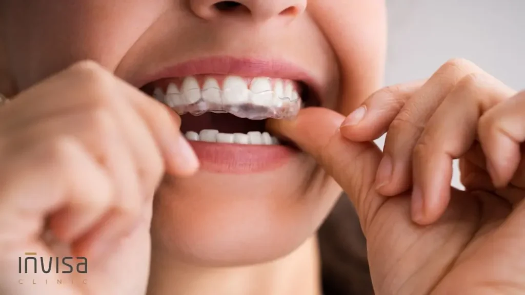 Aparelho Dentário Invisível: Diastema