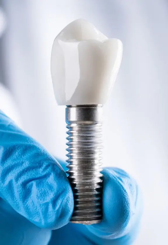 Implante Dentário