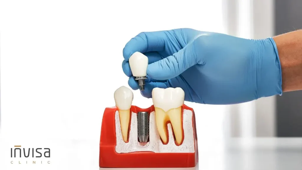 Dentista especialista mostrando implante dentário ao paciente