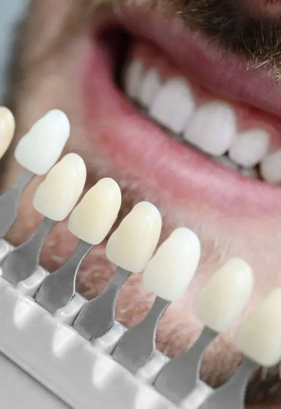 Lente de Contato Dental e São Paulo SP