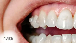 Esquema da alavanca biomecânica que explica attachment alinhador como funciona na geometria do dente.