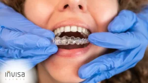 Como o alinhador movimenta o dente em arcada dentária superior com lâmina transparente.