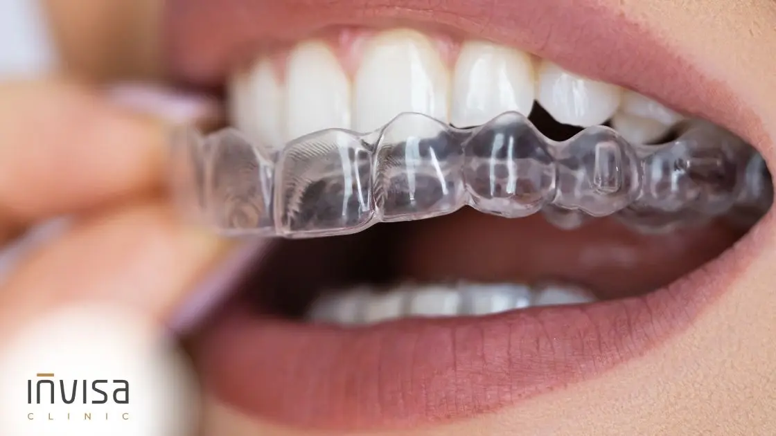 Biomecânica do alinhador invisível em arcada dentária superior, renderizada em 3D